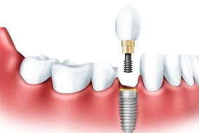 http://welldentclinic.ru/wp-content/uploads/2020/08/ekspress-implantatsiya1.jpeg