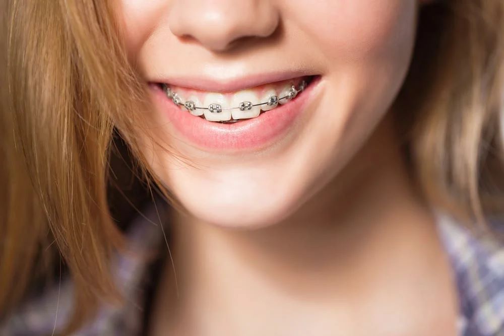 brekety https://welldentclinic.ru/wp-content/uploads/2021/02/brekety.jpg